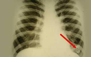 Хронический абсцесс легкого — причины, симптомы, диагностика и методы лечения