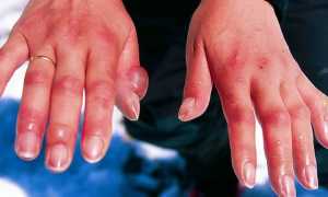 Мазь календулы — инструкция по применению и отзывы