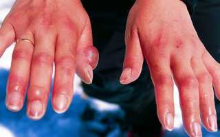 Мазь календулы — инструкция по применению и отзывы