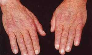 Общие сведения о дерматофитии кистей рук