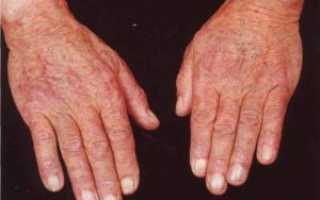 Общие сведения о дерматофитии кистей рук