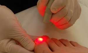 Как при помощи лазера лечить грибок ногтей?