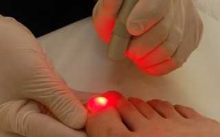 Как при помощи лазера лечить грибок ногтей?