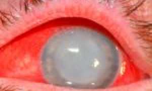 Опасное инфекционное заболевание – кандидоз глаз