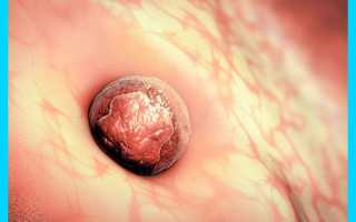 Имплантационное кровотечение: сколько дней длится и когда начинается