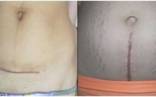 Рубец на матке после кесарева: виды и возможные осложнения