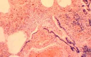 Агранулоцитоз у детей — симптомы и причины заболевания, диагностика