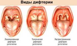 Что такое дифтерия и меры профилактики заболевания