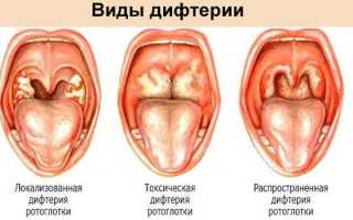 Что такое дифтерия и меры профилактики заболевания