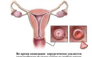 Беременность после конизации шейки матки: особенности протекания и родоразрешения