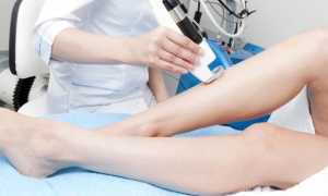 Лечение варикоза лазером — показания, особенность процедуры и цена