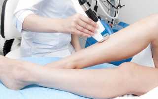 Лечение варикоза лазером — показания, особенность процедуры и цена