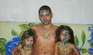 Прививка от ветрянки детям и взрослым: инструкция, где сделать, отзывы и цена