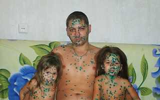 Прививка от ветрянки детям и взрослым: инструкция, где сделать, отзывы и цена