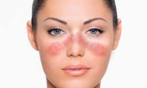 Красная волчанка