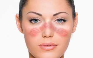 Красная волчанка