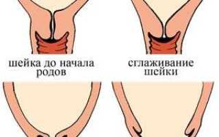 Незрелая шейка матки: возможны ли естественные роды?