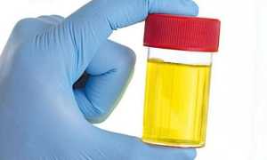 Моча на диастазу — как сдавать и расшифровка результатов, нормальные показатели для детей и взрослых