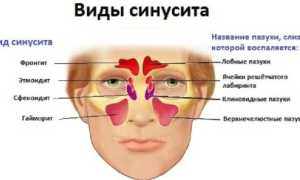 Катаральный синусит: симптомы и лечение заболевания