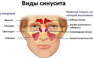 Катаральный синусит: симптомы и лечение заболевания