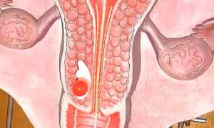 Дисплазия шейки матки: что это