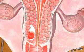 Дисплазия шейки матки: что это