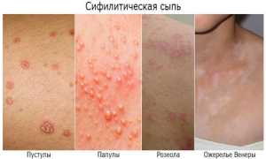 Симптомы и лечение сифилиса, течение инфекционного заболевания