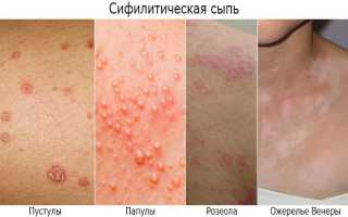 Симптомы и лечение сифилиса, течение инфекционного заболевания