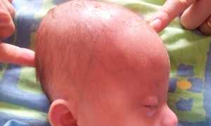 Причины гипертензионно-гидроцефального синдрома у детей по возрасту