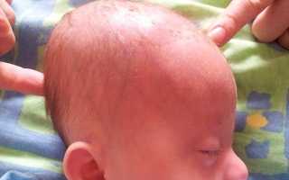 Причины гипертензионно-гидроцефального синдрома у детей по возрасту