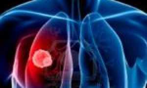 Опасное инфекционное заболевание – кандидоз легких