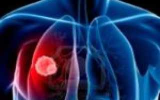 Опасное инфекционное заболевание – кандидоз легких