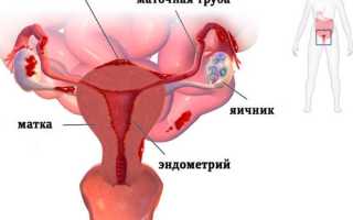 Как связаны эндометриоз и бесплодие?