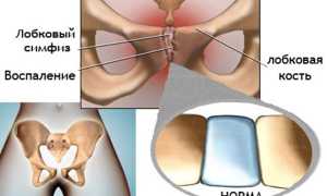 Симфизит при беременности
