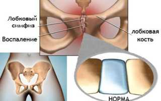 Симфизит при беременности