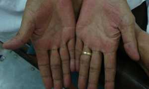 Признаки цирроза печени на ранней стадии: первые симптомы болезни