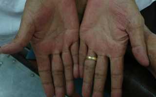 Признаки цирроза печени на ранней стадии: первые симптомы болезни