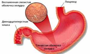 Симптомы и лечение атрофического гастрита