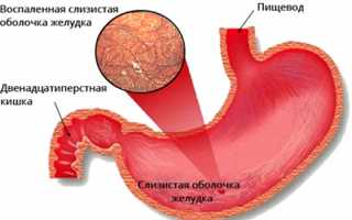 Симптомы и лечение атрофического гастрита