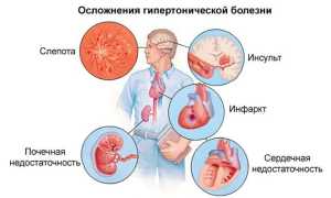 Симптомы гипертонии у женщин — причины, первые признаки и проявления, методы лечения, возможные осложнения