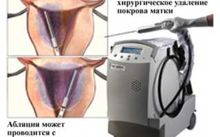Что такое аргоноплазменная абляция шейки матки?