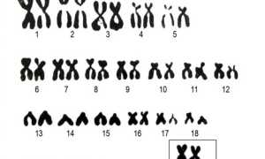 Синдром Клайнфельтера