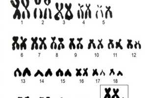 Синдром Клайнфельтера