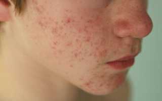 Эффективное лечение демодекоза лица