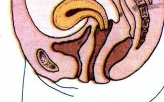 Загиб матки кпереди или антефлексия: особенности явления