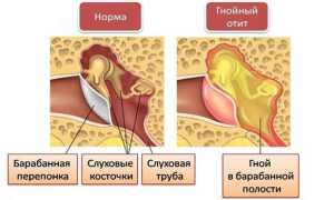 Отит у взрослых — причины, симптомы и лечение в домашних условиях