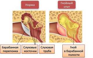 Отит у взрослых — причины, симптомы и лечение в домашних условиях