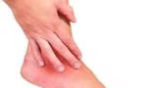 Отличия везикулярного грибка от других видов и способы его лечения