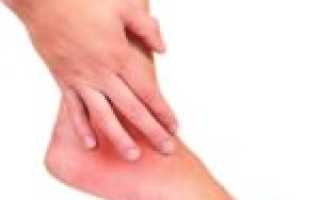 Отличия везикулярного грибка от других видов и способы его лечения