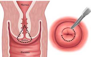Круговая биопсия шейки матки: показания, как проводится, стоимость